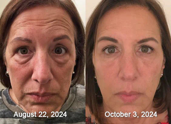 BotoxLux Restauração Facial