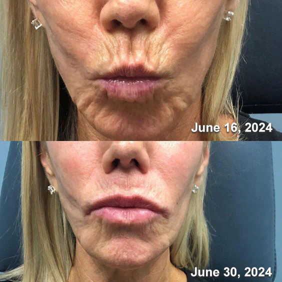 BotoxLux Restauração Facial