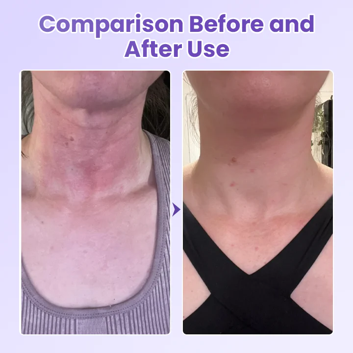 Adeus Papada Patch - Adesivo Antirrugas Para Pescoço