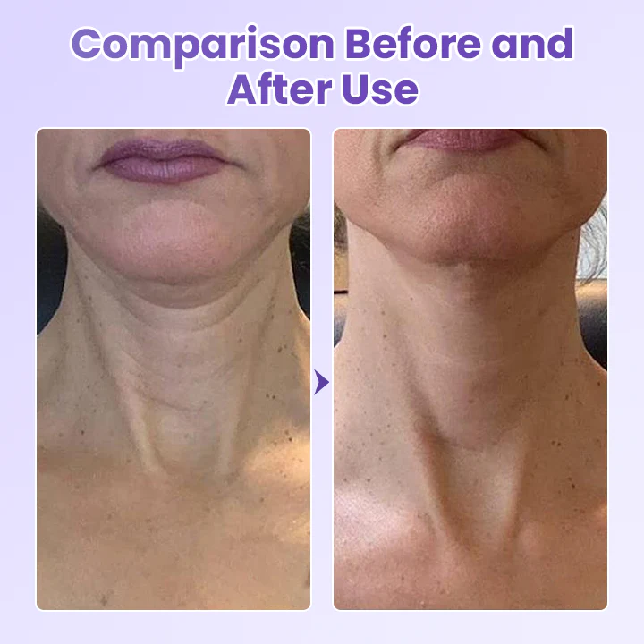 Adeus Papada Patch - Adesivo Antirrugas Para Pescoço